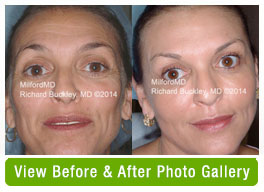 BA face lift By MilfordMD