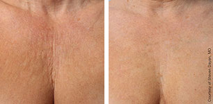 1-Ultherapy Chest By MilfordMD