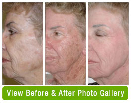 Before and after Omnilux foto facial