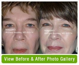 Before and after fat transfer to the face