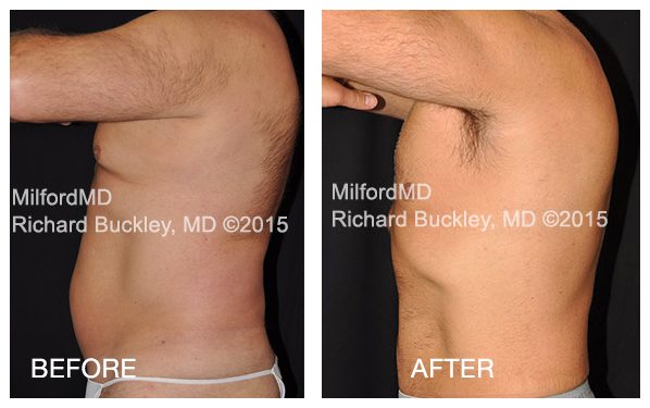 Male abs media BA By MilfordMD