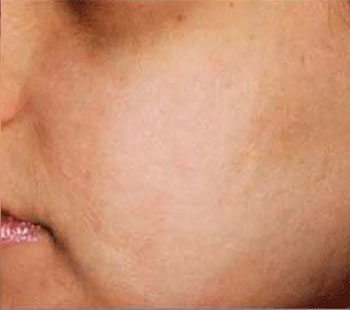 After SmoothBeam™ Acne Scar Treatment