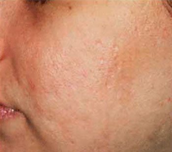 Before SmoothBeam™ Acne Scar Treatment