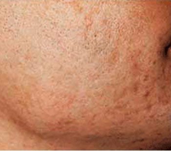 After SmoothBeam™ Acne Scar Treatment