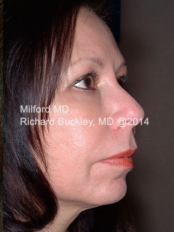 After Facelift with Fat Transfer and Neck Lift Side View