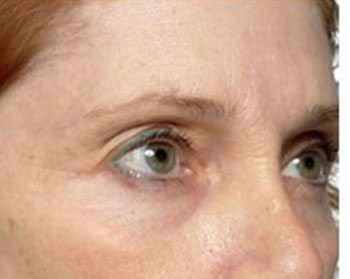 Before Thermage Brow Lift