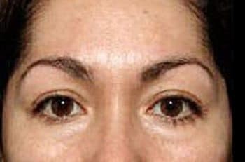 Before Thermage® Brow Lift