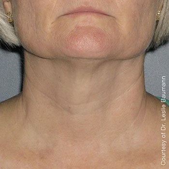 After Ultherapy® Neck Lift