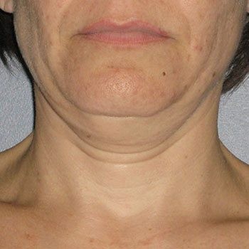 Before Ultherapy® Neck Lift