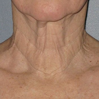 Before Ultherapy® Neck Lift