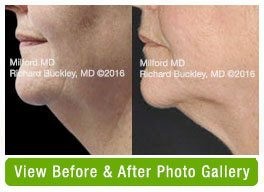Before and After Coolsculpting Neck Fat