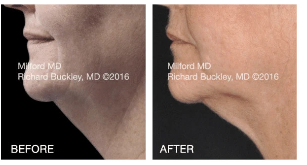 Coolsculpting neck By Milford