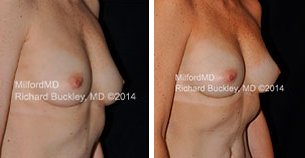 Before & After Breast Augmentation with Fat