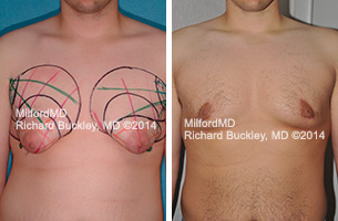 Before & After Gynecomastia Surgery in Milford PA