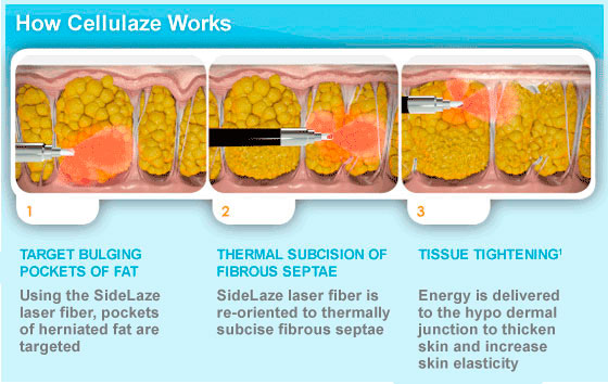 How Cellulaze Works