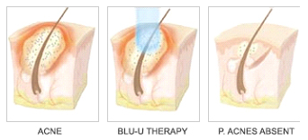 Blue Light Treatment,Blue light treatment in Milford,Blue light treatment Therapy in PA, Blu-U (Light)