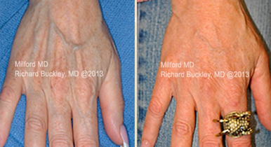 Hand Rejuvenation,Hand Rejuvenation in Milford PA,Fat transfer to hands in Milford PA,Hand Rejuvenation treatment near me, Hand Rejuvenation