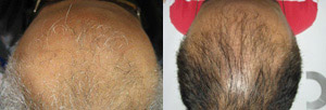 Hair Restoration Scranton PA
