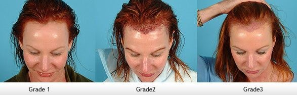 hair loss women