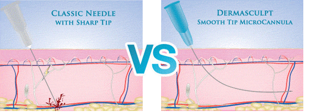 needles vs microcannulas