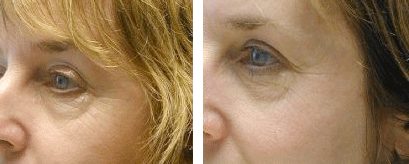Light Therapy for Wrinkles,Omnilux™ light therapy in Milford PA,Therapy for wrinkle in Milford PA,Omnilux™ light therapy near me, Light Therapy for Wrinkles