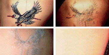 Laser Tattoo Removal  Butterfly Medical Spa