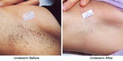 underarm_before-after