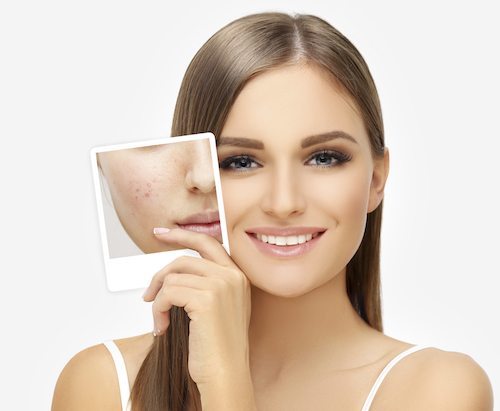 Acne Conditions We Treat