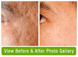 Acne Scar Treatment Before & After Gallery