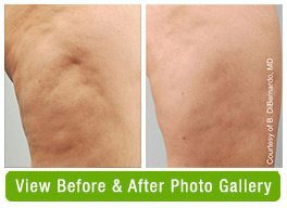 Cellulite Reduction Before & After Gallery