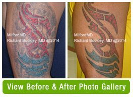 Tattoo Removal Before & After Gallery