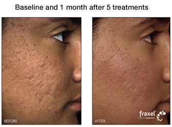 Fraxel for Facial Acne