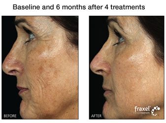 Fraxel for Facial Acne