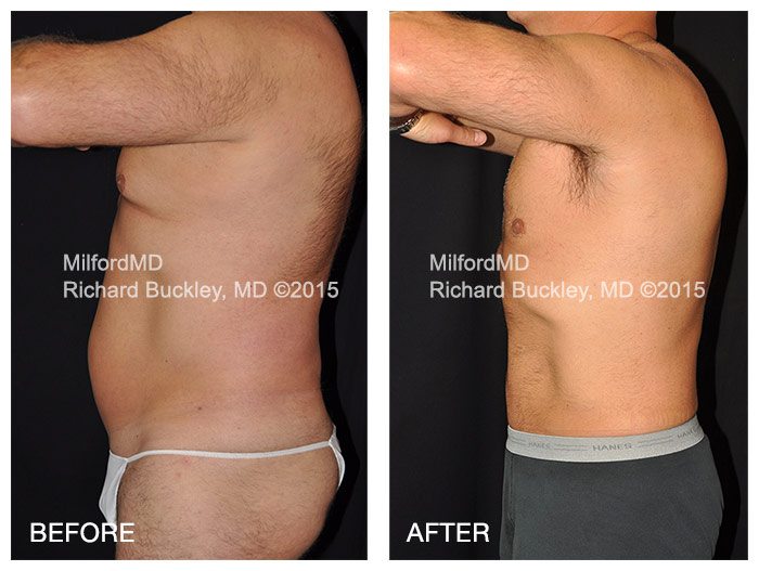 BA-lipo-male-waist-hips | fat removal | MilfordMD Cosmetic Dermatology Surgery & Laser Center