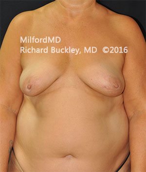 Before: BREAST AUGMENTATION – CASE #36115
