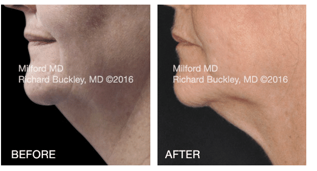 Coolsculpting-neck | MilfordMD Cosmetic Dermatology Surgery & Laser Center