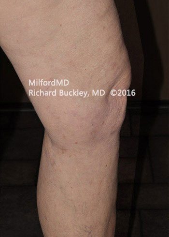 After Sclerotherapy Vein Treatment