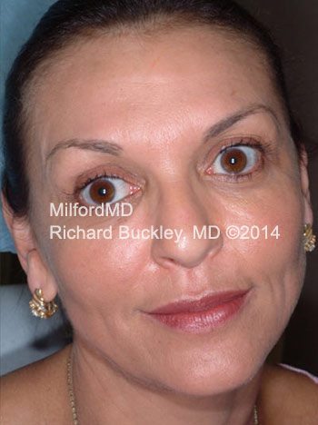 After Before BOTOX® Cosmetic