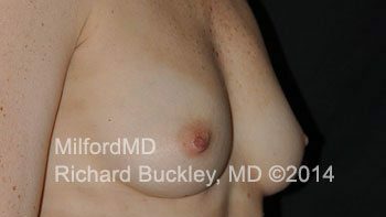 Before: BREAST AUGMENTATION AFT – Case #35877