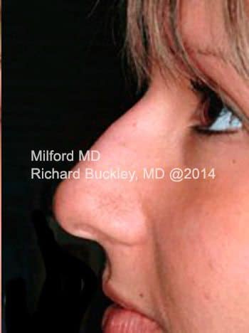 After Non-Surgical Rhinoplasty