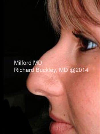 Before Non-Surgical Rhinoplasty