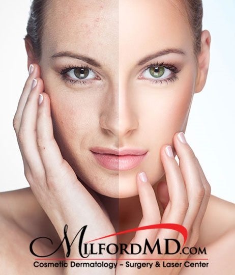 Sunspot before and after results of a lady | MilfordMD Cosmetic Dermatology Surgery & Laser Center in Milford, PA