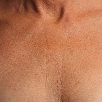 Before Ultherapy® Décolletage Rejuvenation