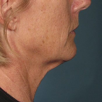 After Ultherapy® Face & Jowl Lift