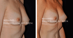 Breast Augmentation Scranton PA
