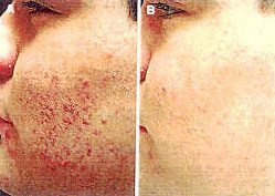 Microdermabrasion and Acne