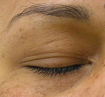 After HydraFacial MD® Treatment