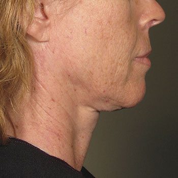 Before Ultherapy® for Lower Face