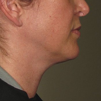 After Ultherapy® for Lower Face
