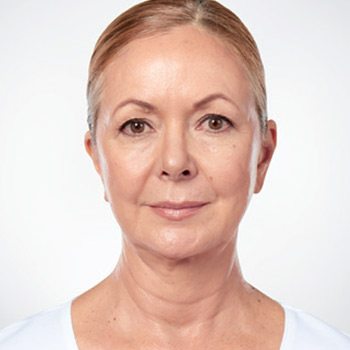 After Kybella® Neck Tightening Treatment